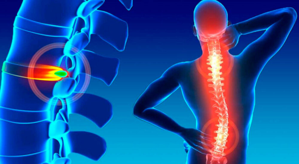 Tratamentos de Hernia de Disco Fisioterapia